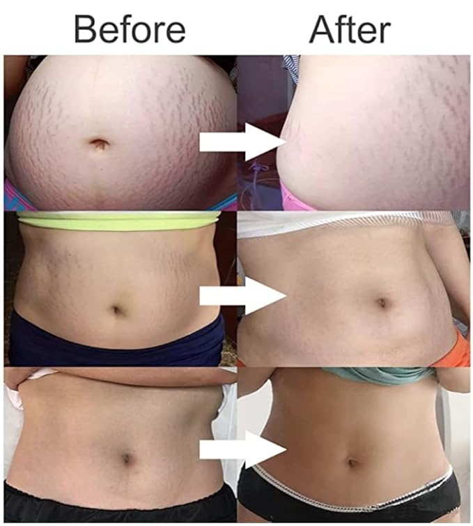 Stretch Mark Cream 120g/4 oz Stretch Marks Lotion Pregnancy Creams, Belly Butter Pregnant Women Stretch Mark Removal Treatment, Maternity Skin Care Moisturizer Scar Wrinkle Prevention