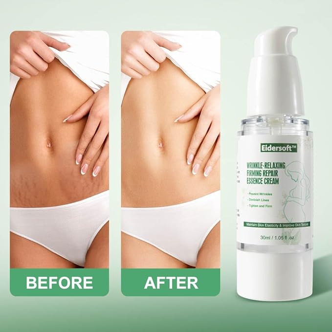 Wrinkle-Relaxing Firming Repair Essence Cream - Removes Maternity Stretch Marks, Prevents Wrinkles & Fine Lines, Nourishes & Rejuvenates Skin with Safe, Natural Formula