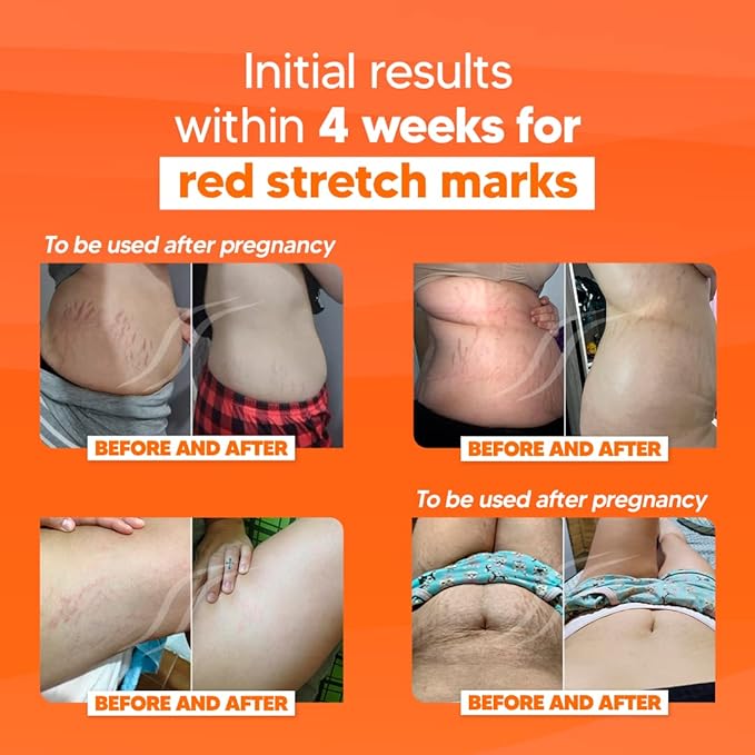 Cicatrissim Deep Stretch Mark Removal Cream - Innovative Formula With Pure and Powerful Natural Ingredients From Brazilian Flora - For All Stretch Marks & Skin Types.