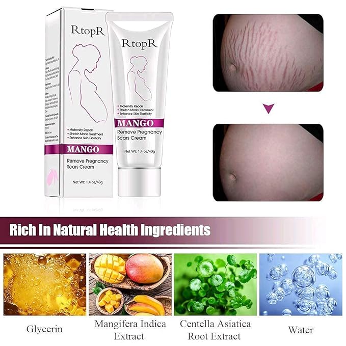 RtopR Mango Stretch Marks and Scar Cream -Stretch Marks and Scar Removal Cream for Pregnancy - Best Body Moisturizer-80g