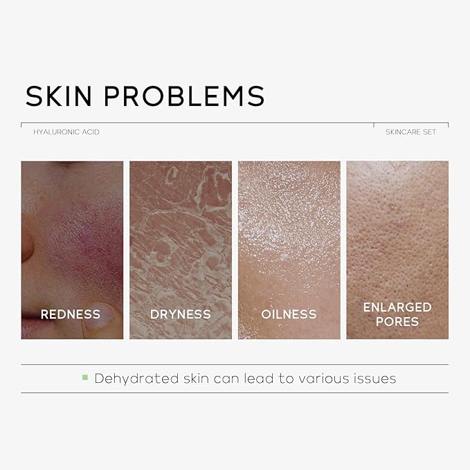 Hydrating Skin Care Set, Hyaluronic Acid Skin Care Kit with Serum for Face, Moisturizer, Travel Size Face Care Set for Women, Anti Aging Plumping Hydrating Firming for Dry Skin