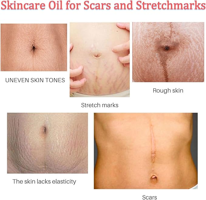 Stretch Mark Pregnancy Massage Oil, Stretch Mark Oil, Skincare Oil for Improve Stretchmarks, Pregnancy Skin Care Fade Stretch Marks, Body Moisturizer for Dry Skin, First Time Mom Gift 30 ml