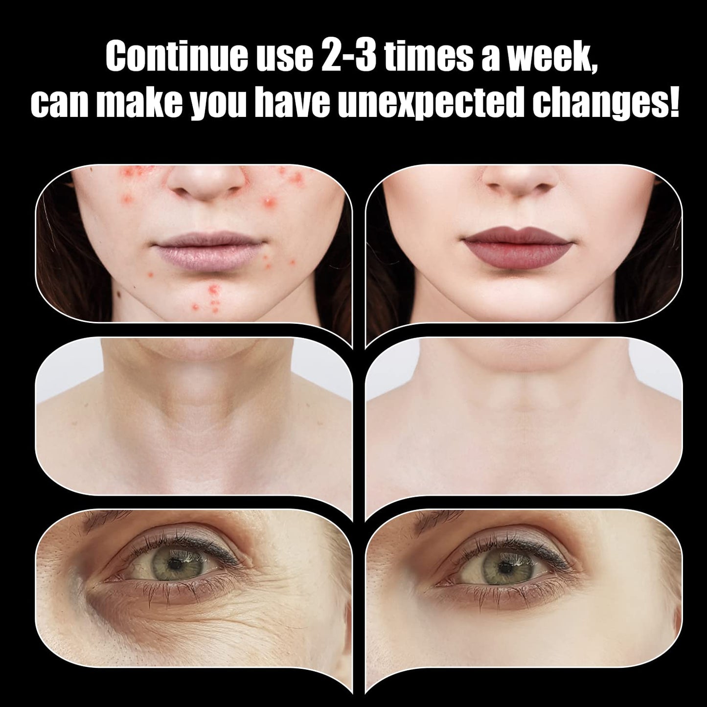 High Frequency Facial Wand - UUPAS Portable High Frequency Facial Machine with 6 Pcs Different Tubes（Orange & Purple）