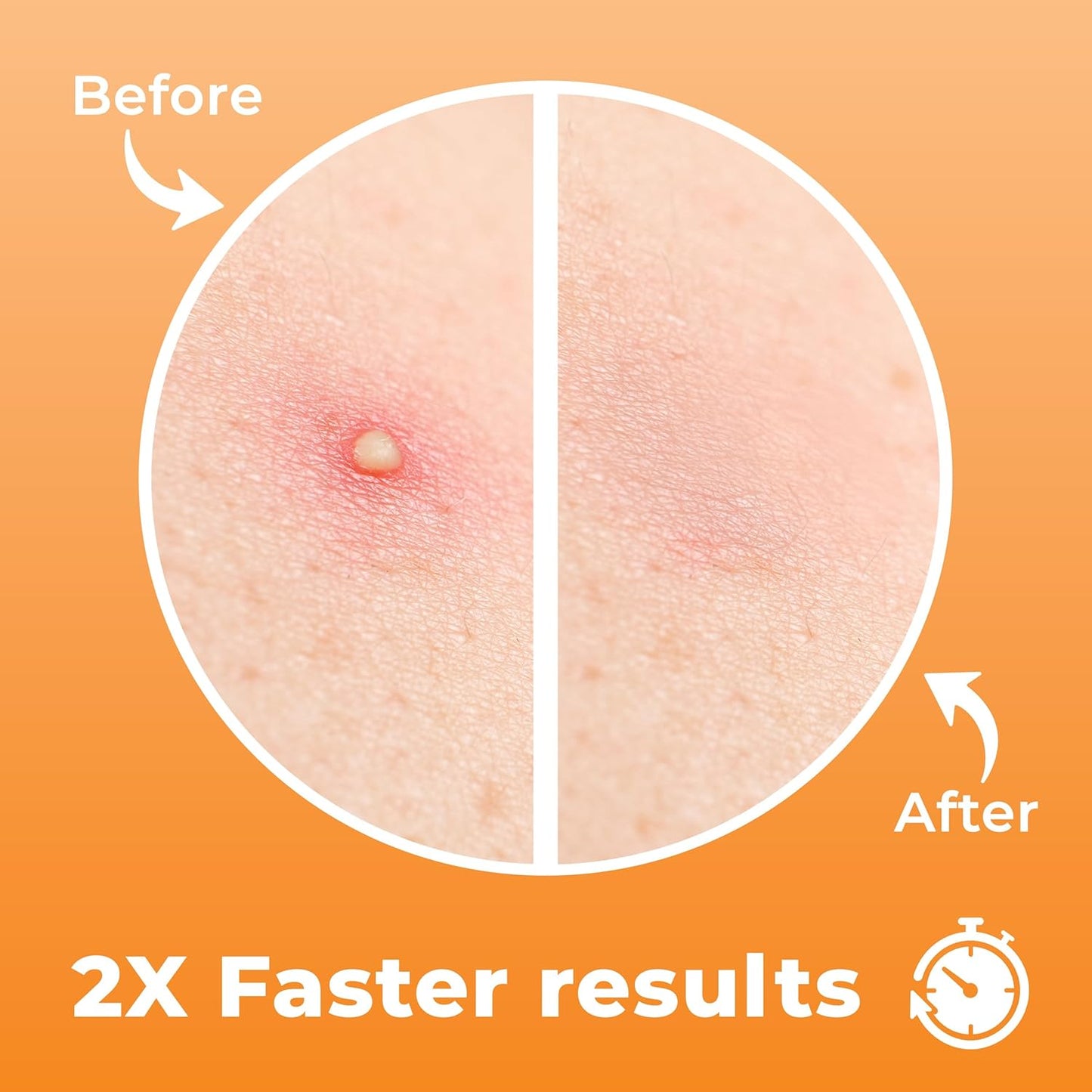 Chin Pimple Patches (12 Pack), Remove Chin Acne Overnight with Large Hydrocolloid Acne Patches For Blemishes on Chin, Cheek, Forehead