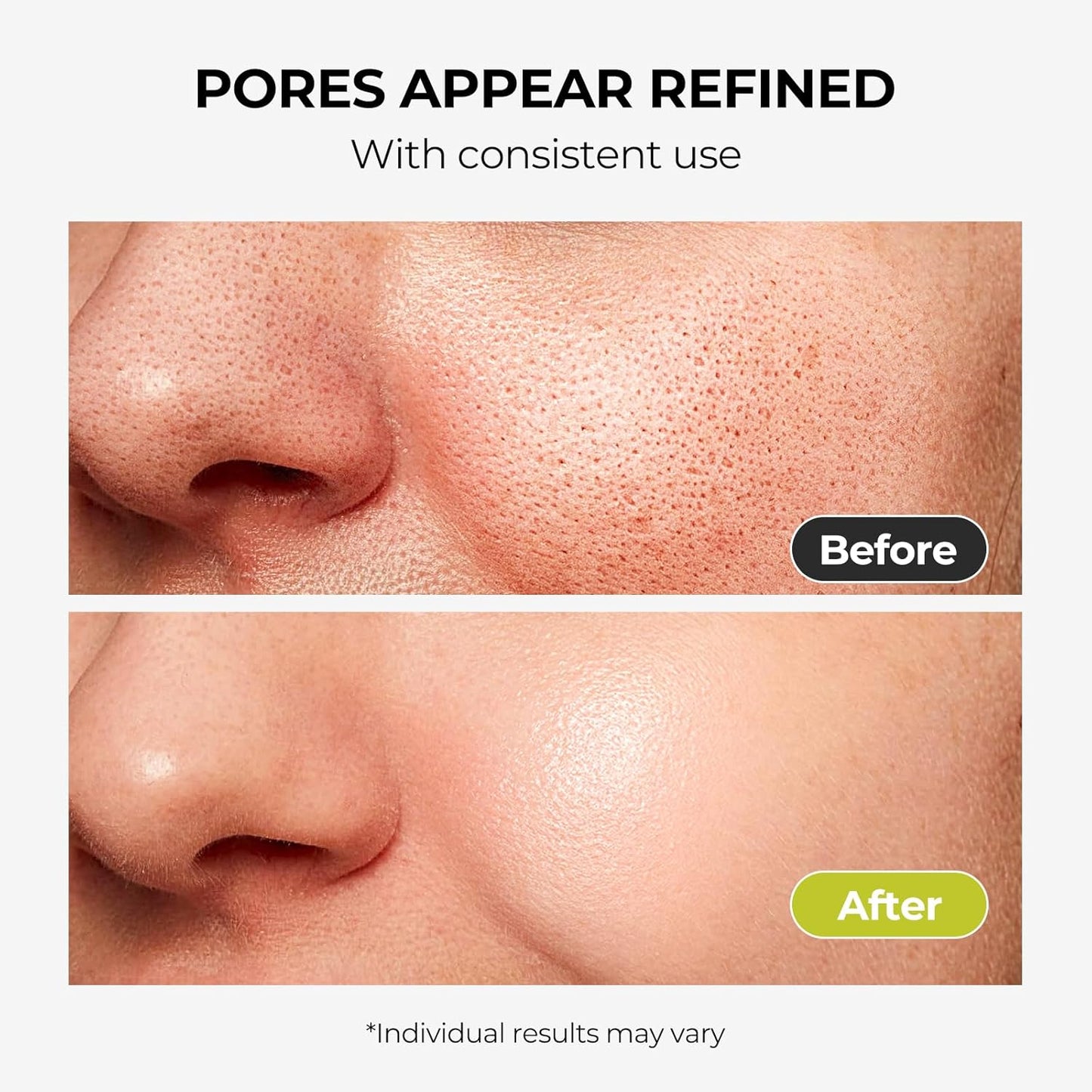 2% Salicylic Acid Face Serum for Oily, Blemish-Prone Skin - Treatment with Witch Hazel to Control Oil, Minimize Pores, Exfoliating & Soothing Skin - For Men & Women, 1.01 Fl Oz.