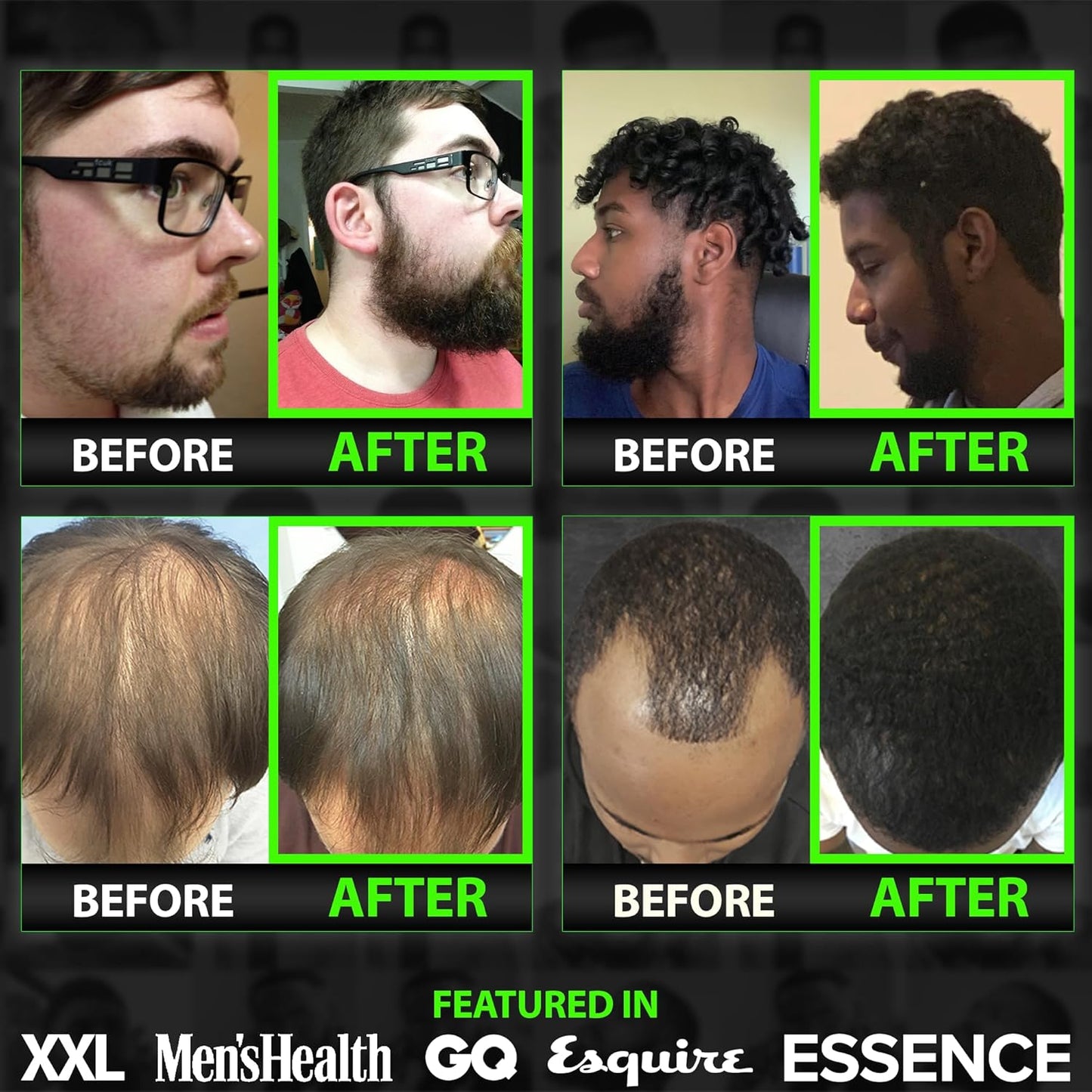 Beard Growth Serum - GROW Maximum XXL Beard Growth Oil for Men -Thickens & Fills Patches - Facial Hair & Scalp Treatment - Beard & Hair Thickening Conditioner & Enhancer